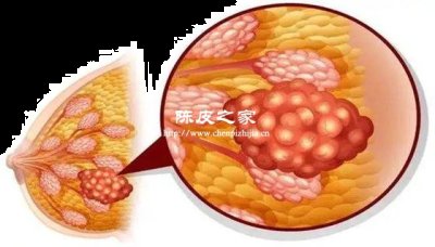 乳腺增生用陳皮泡水喝好嗎