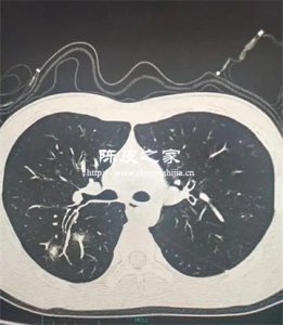 陳皮可以用來預防支原體肺炎嗎