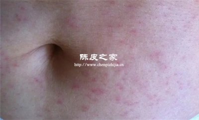 38度喝蠶砂竹茹陳皮水有傷害嗎