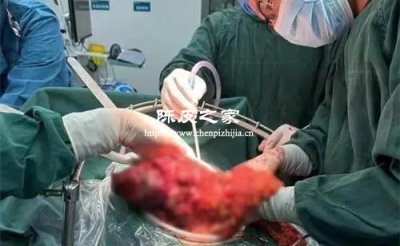 直腸癌手術后可以喝陳皮水嗎