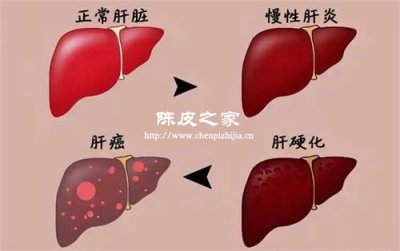陳皮提取物在酒精性肝損傷修復中的潛力